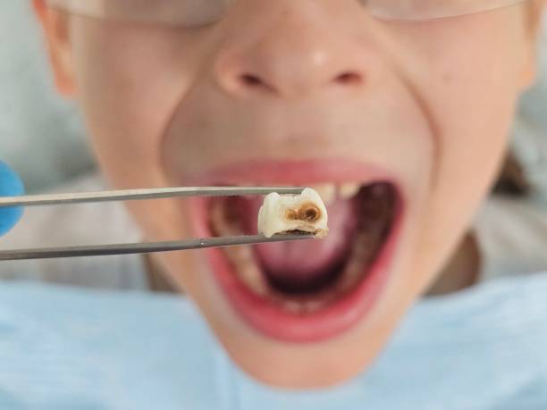 Best Broken or Chipped Tooth Repair in Alexandria, VA